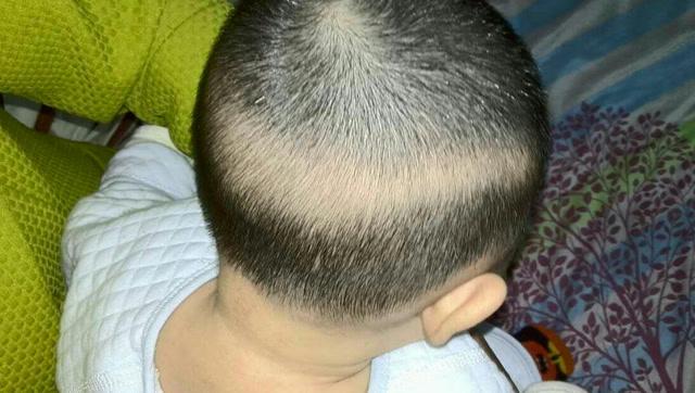 代孕妈妈宝宝头发少缺什么